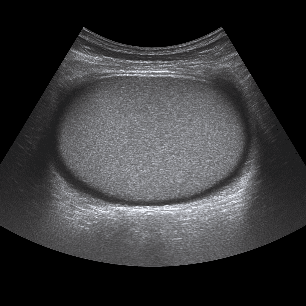 Ultrasound Testicles