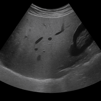 Ultraljud Liver