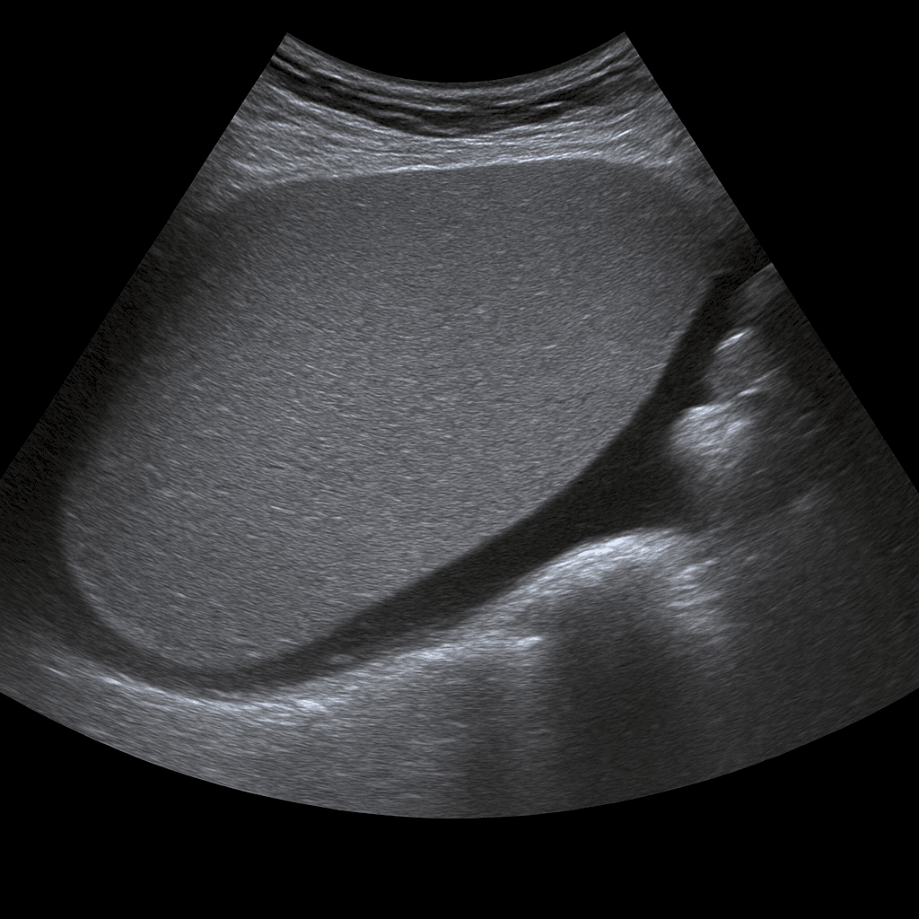 Ultrasound Spleen