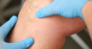 Ont i knät? Här är de vanligaste knäskadorna – och när MR behövs