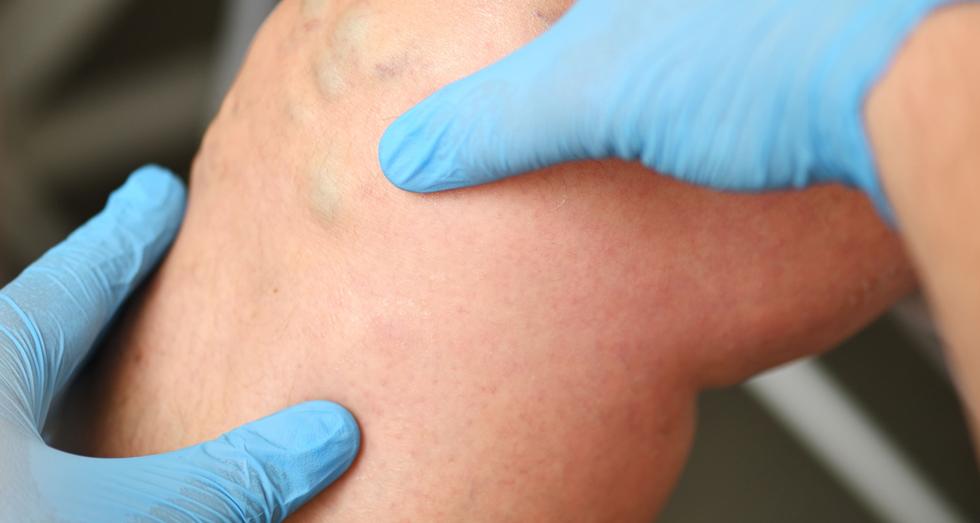 Ont i knät? Här är de vanligaste knäskadorna – och när MR behövs