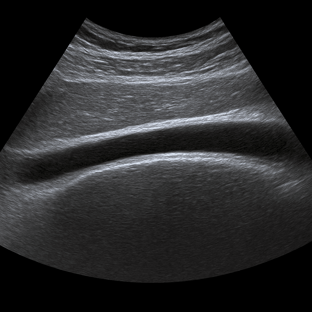 Ultrasound achilles tendon