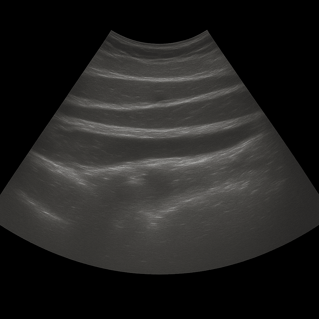 Ultrasound abdominal wall