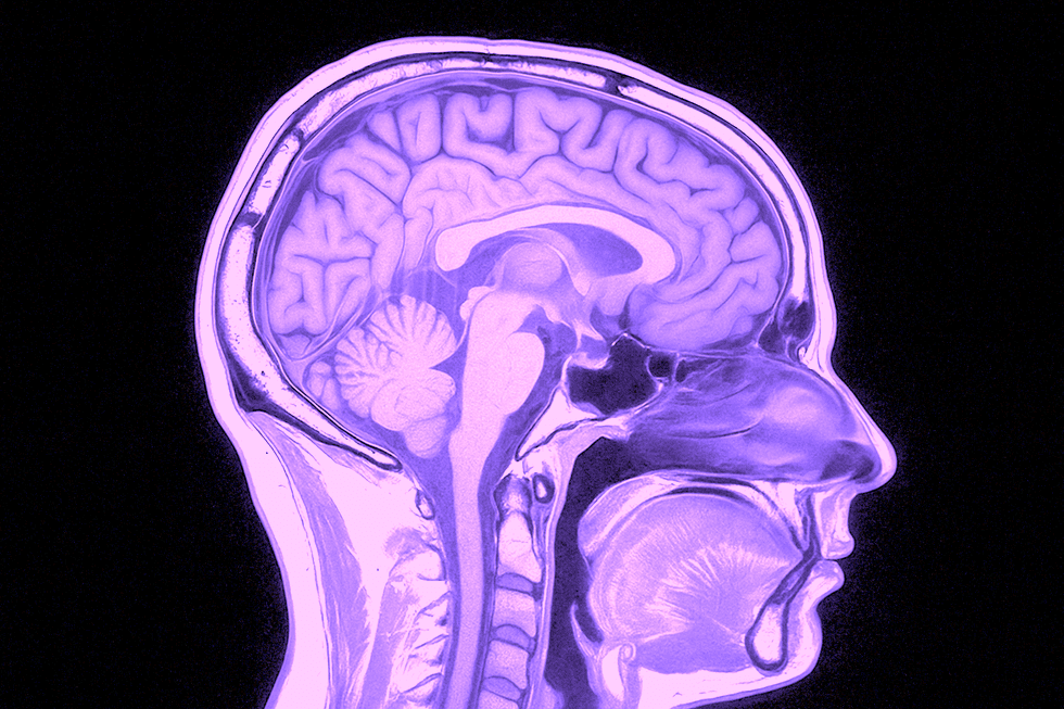 What does an MRI scan of the brain show?