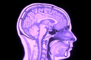 What does an MRI scan of the brain show?