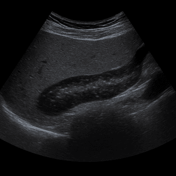 Ultraljud Pancreas