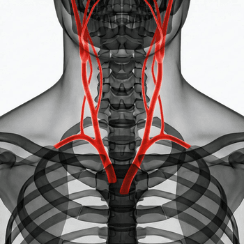 CT carotid arteries - 3D Angio